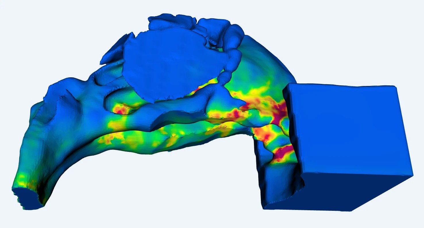 Wall Shear Stress after the virtual surgery