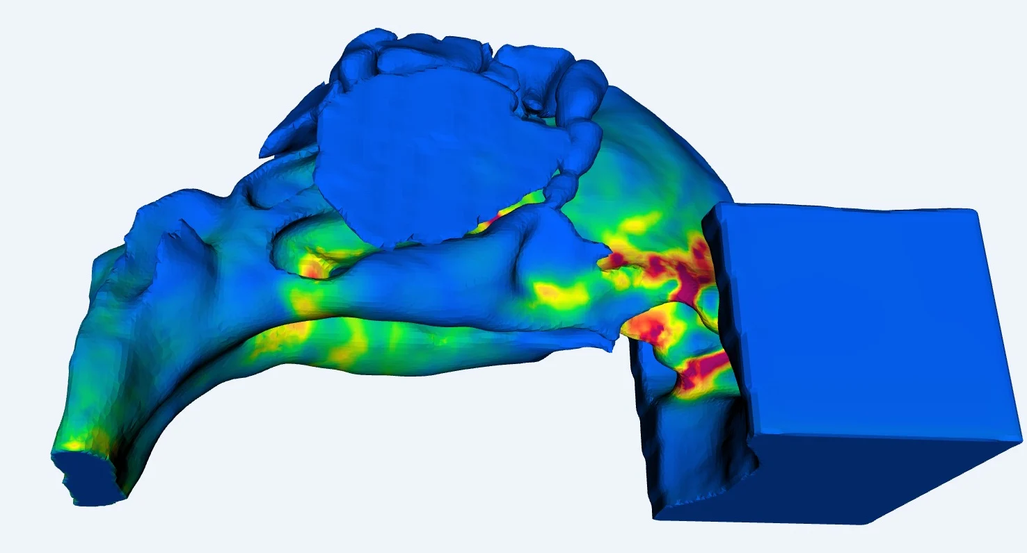 Wall Shear Stress before the virtual surgery